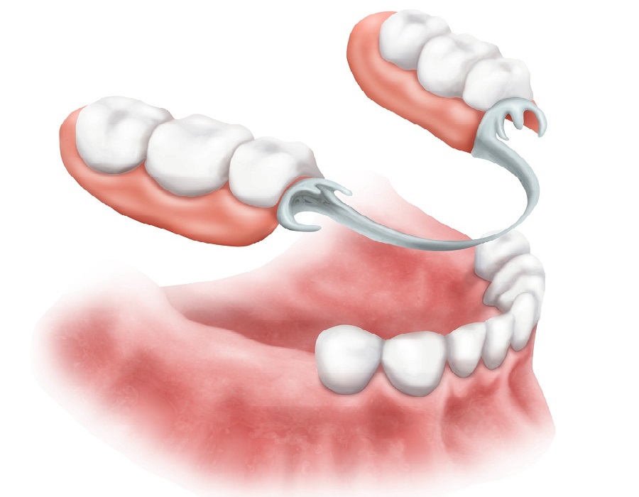 Plaat- of frameprothese 